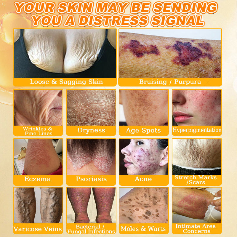 🐝🔥FDA Approved|Cheemex® Bee Venom Skin Restoration Cream (Anti-aging. Hydrating. Skin Repair. Even Tone. Acne and Dark Spot Treatment. Wart and Mole Removal. Psoriasis Relief)