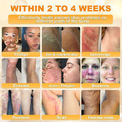 🐝🔥FDA Approved|Cheemex® Bee Venom Skin Restoration Cream (Anti-aging. Hydrating. Skin Repair. Even Tone. Acne and Dark Spot Treatment. Wart and Mole Removal. Psoriasis Relief)