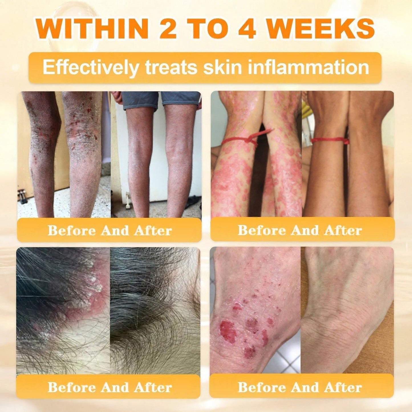 🐝🔥FDA Approved|Cheemex® Bee Venom Skin Restoration Cream (Anti-aging. Hydrating. Skin Repair. Even Tone. Acne and Dark Spot Treatment. Wart and Mole Removal. Psoriasis Relief)