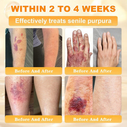 🐝🔥FDA Approved|Cheemex® Bee Venom Skin Restoration Cream (Anti-aging. Hydrating. Skin Repair. Even Tone. Acne and Dark Spot Treatment. Wart and Mole Removal. Psoriasis Relief)