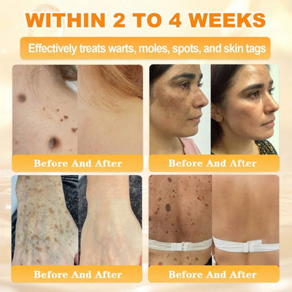 🐝🔥FDA Approved|Cheemex® Bee Venom Skin Restoration Cream (Anti-aging. Hydrating. Skin Repair. Even Tone. Acne and Dark Spot Treatment. Wart and Mole Removal. Psoriasis Relief)